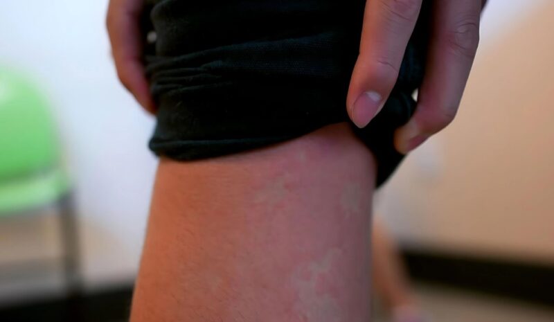Vape rash symptoms